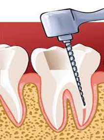 dévitalisation dents